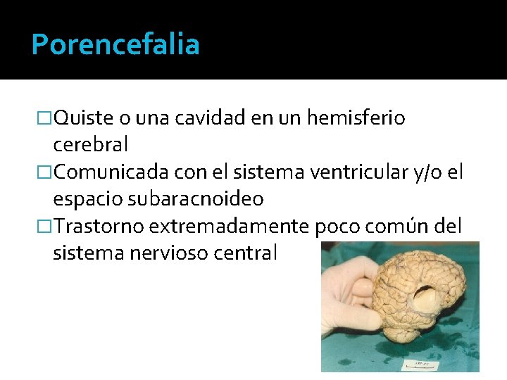 Porencefalia �Quiste o una cavidad en un hemisferio cerebral �Comunicada con el sistema ventricular