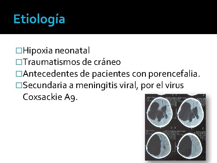 Etiología �Hipoxia neonatal �Traumatismos de cráneo �Antecedentes de pacientes con porencefalia. �Secundaria a meningitis