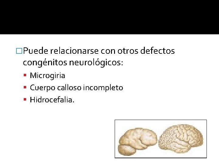 �Puede relacionarse con otros defectos congénitos neurológicos: Microgiria Cuerpo calloso incompleto Hidrocefalia. 