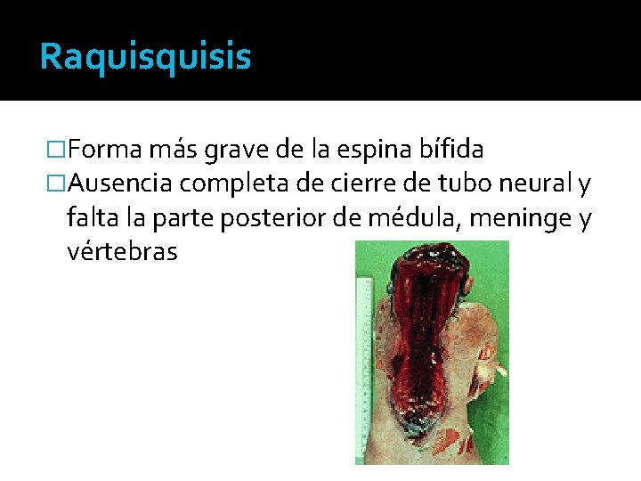 Raquisis �Forma más grave de la espina bífida �Ausencia completa de cierre de tubo