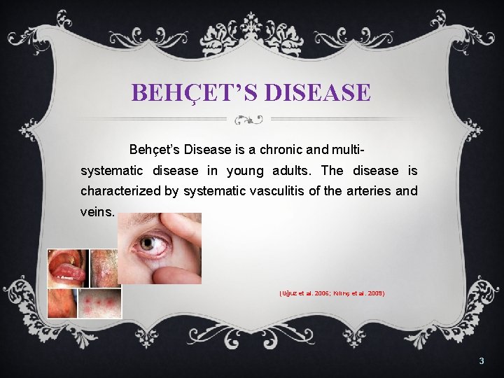BEHÇET’S DISEASE Behçet’s Disease is a chronic and multisystematic disease in young adults. The
