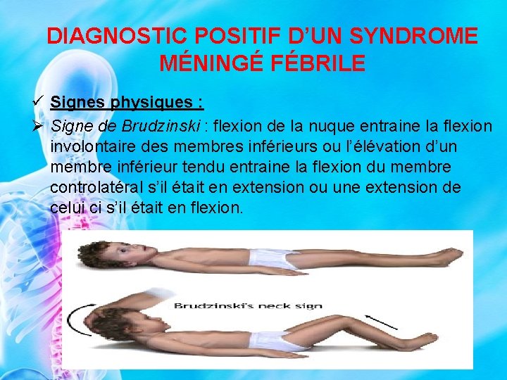 DIAGNOSTIC POSITIF D’UN SYNDROME MÉNINGÉ FÉBRILE ü Signes physiques : Ø Signe de Brudzinski