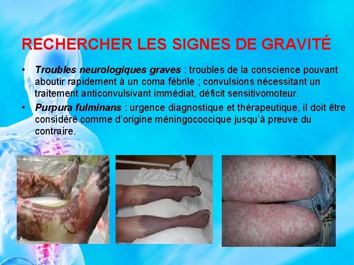 RECHER LES SIGNES DE GRAVITÉ • Troubles neurologiques graves : troubles de la conscience