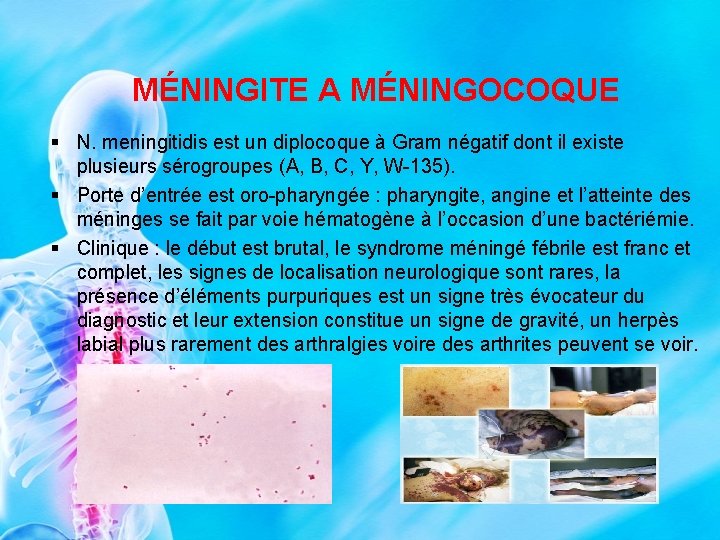 MÉNINGITE A MÉNINGOCOQUE § N. meningitidis est un diplocoque à Gram négatif dont il