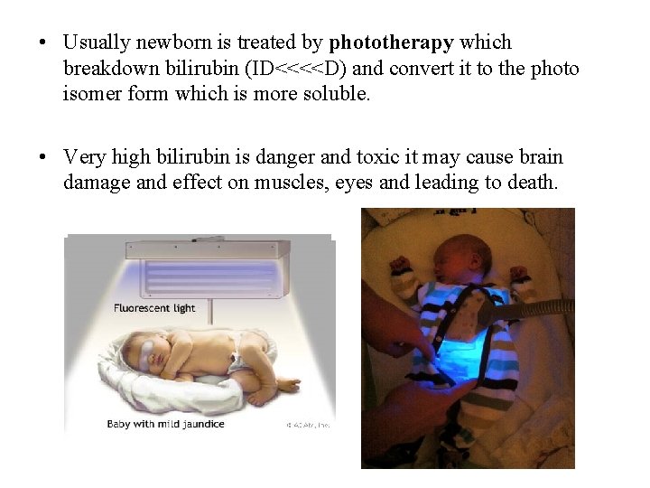  • Usually newborn is treated by phototherapy which breakdown bilirubin (ID<<<<D) and convert