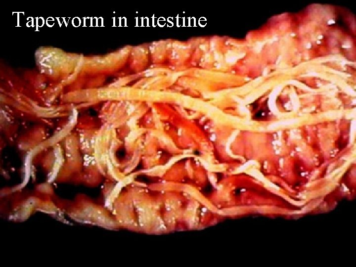 Tapeworm in intestine 