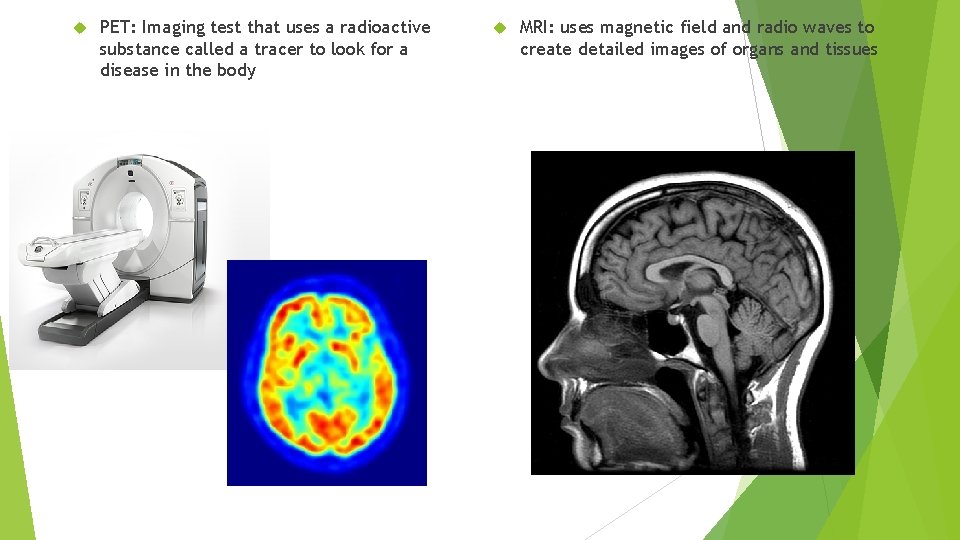  PET: Imaging test that uses a radioactive substance called a tracer to look