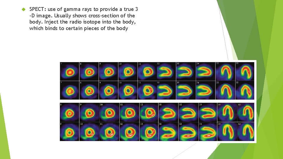  SPECT: use of gamma rays to provide a true 3 -D image. Usually