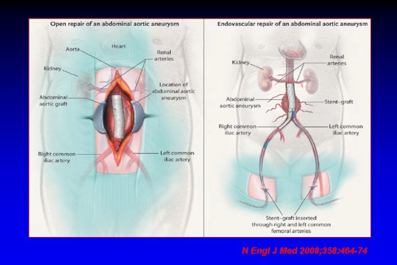 N Engl J Med 2008; 358: 464 -74 