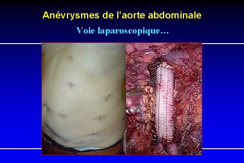 Anévrysmes de l’aorte abdominale Voie laparoscopique… 