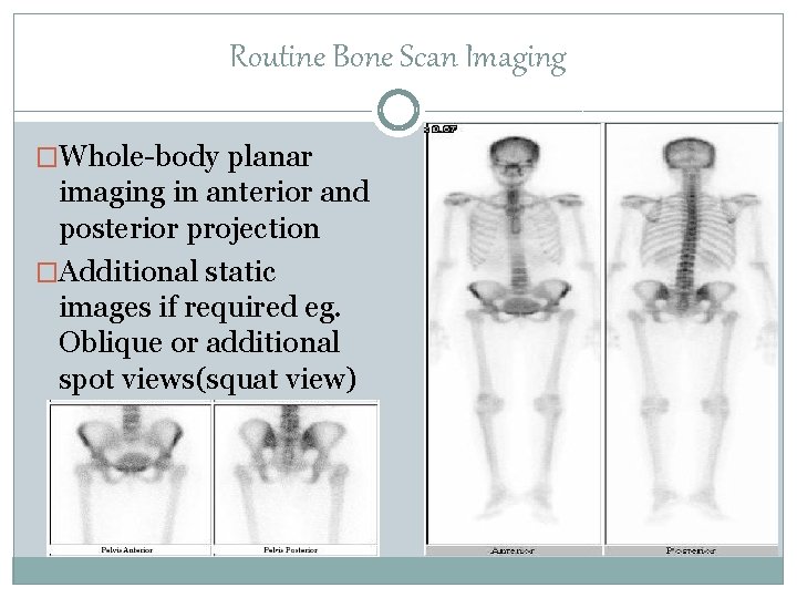 Routine Bone Scan Imaging �Whole-body planar imaging in anterior and posterior projection �Additional static