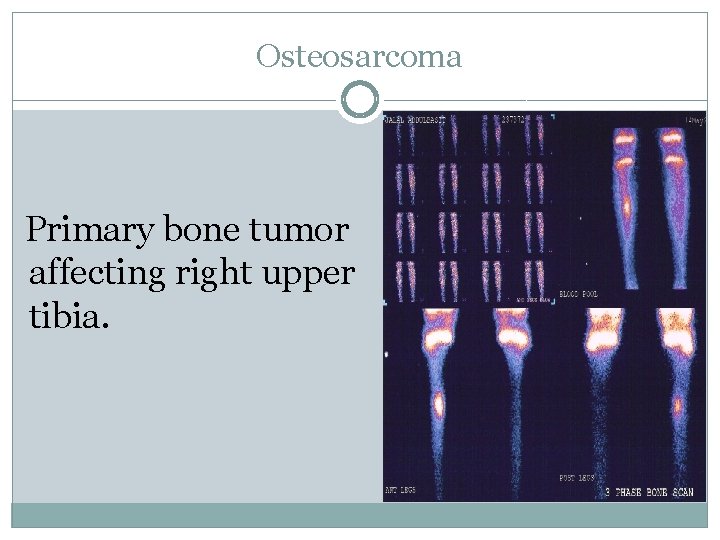 Osteosarcoma Primary bone tumor affecting right upper tibia. 