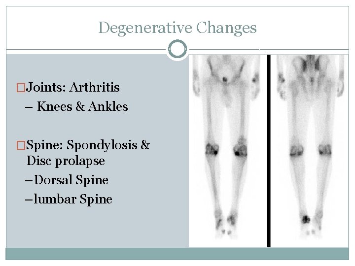 Degenerative Changes �Joints: Arthritis – Knees & Ankles �Spine: Spondylosis & Disc prolapse –Dorsal