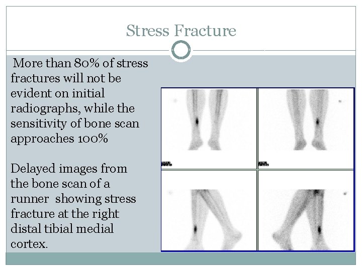 Stress Fracture More than 80% of stress fractures will not be evident on initial