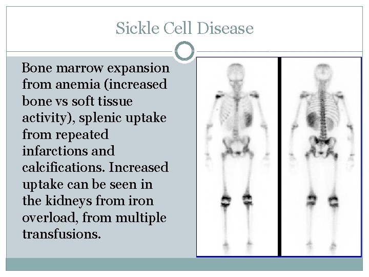 Sickle Cell Disease Bone marrow expansion from anemia (increased bone vs soft tissue activity),