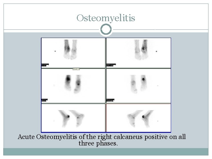 Osteomyelitis Acute Osteomyelitis of the right calcaneus positive on all three phases. 