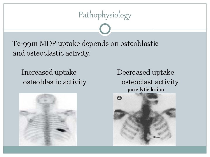 Pathophysiology Tc-99 m MDP uptake depends on osteoblastic and osteoclastic activity. Increased uptake osteoblastic