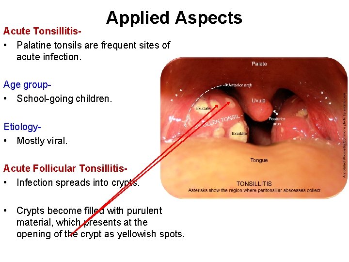 Applied Aspects Acute Tonsillitis • Palatine tonsils are frequent sites of acute infection. Age
