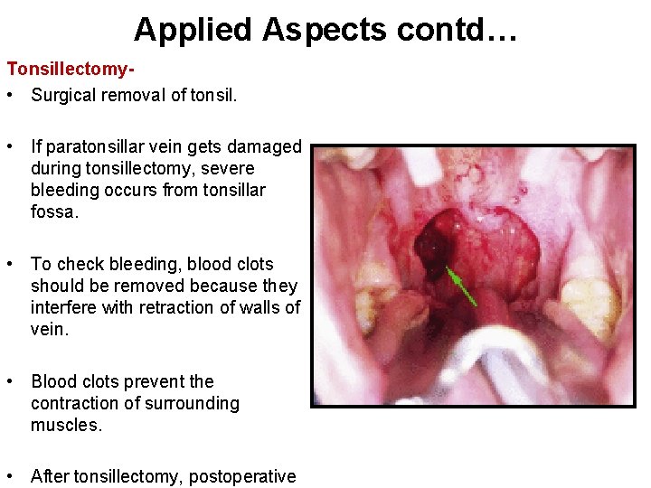 Applied Aspects contd… Tonsillectomy • Surgical removal of tonsil. • If paratonsillar vein gets