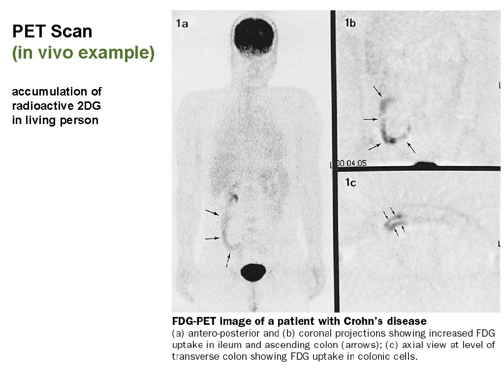 PET Scan (in vivo example) accumulation of radioactive 2 DG in living person 