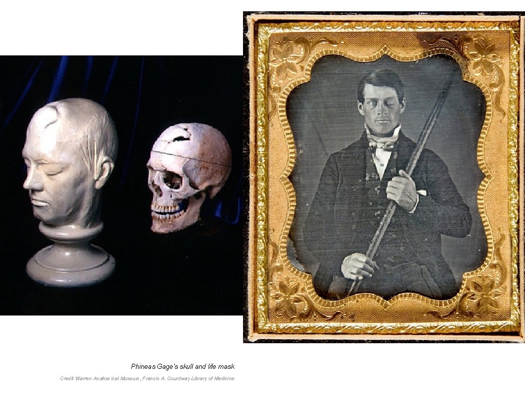 Phineas Gage's skull and life mask Credit Warren Anatomical Museum, Francis A. Countway Library