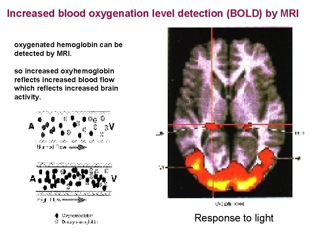 Increased blood oxygenation level detection (BOLD) by MRI oxygenated hemoglobin can be detected by