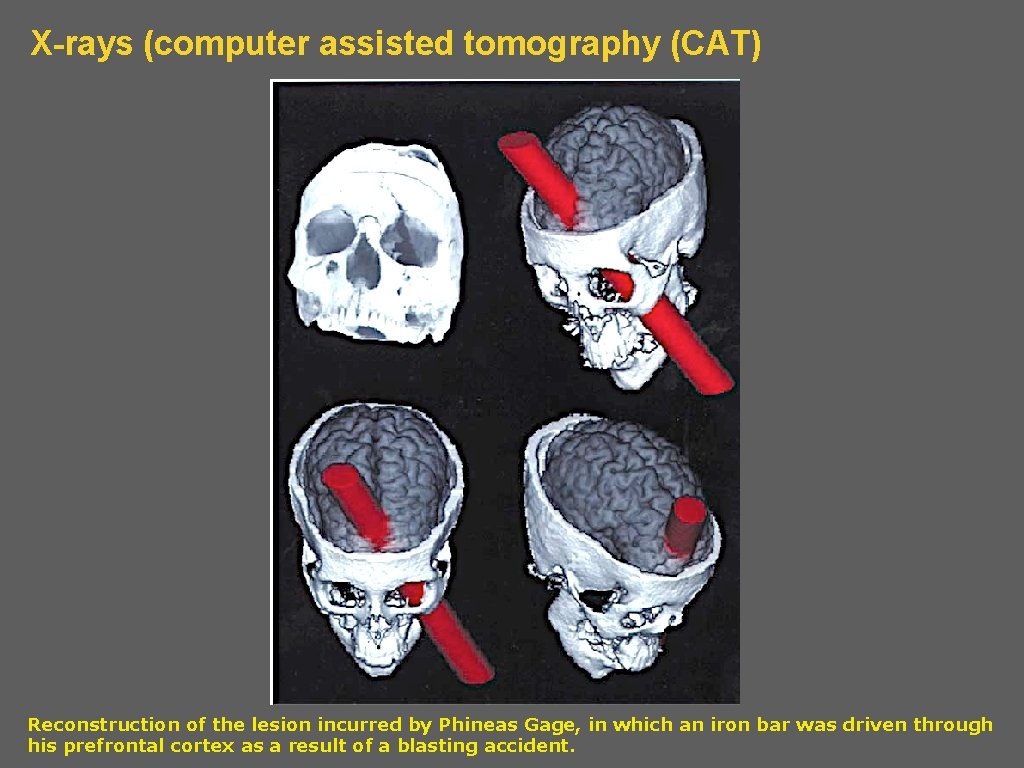 X-rays (computer assisted tomography (CAT) Reconstruction of the lesion incurred by Phineas Gage, in