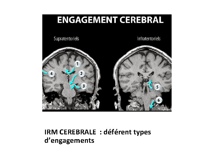 IRM CEREBRALE : déférent types d’engagements 