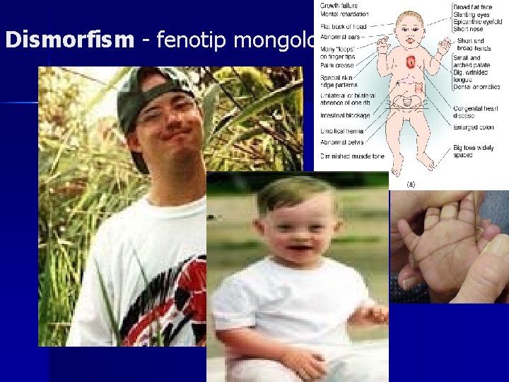 Dismorfism - fenotip mongoloid 