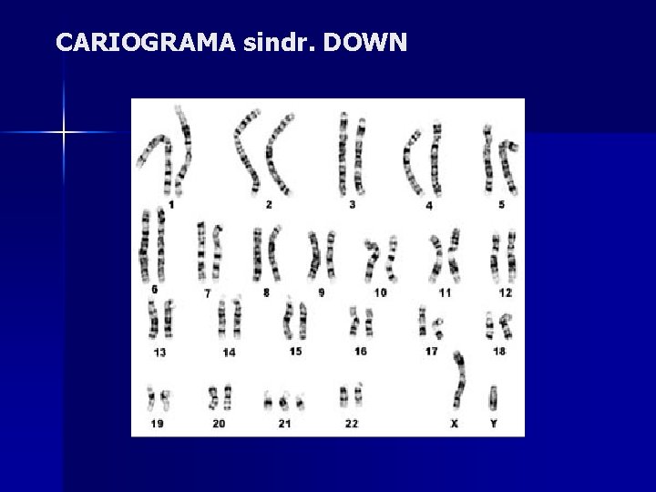 CARIOGRAMA sindr. DOWN 