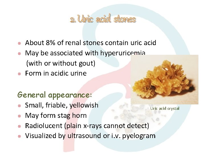 2. Uric acid stones About 8% of renal stones contain uric acid May be