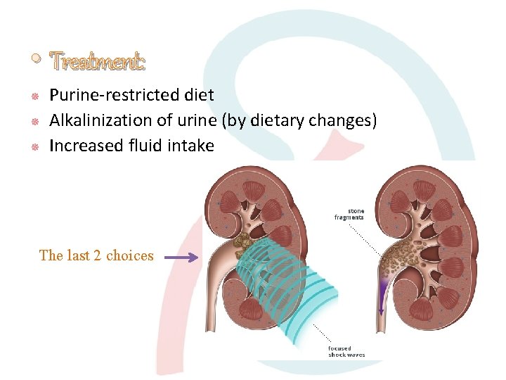  • Treatment: Purine-restricted diet Alkalinization of urine (by dietary changes) Increased fluid intake