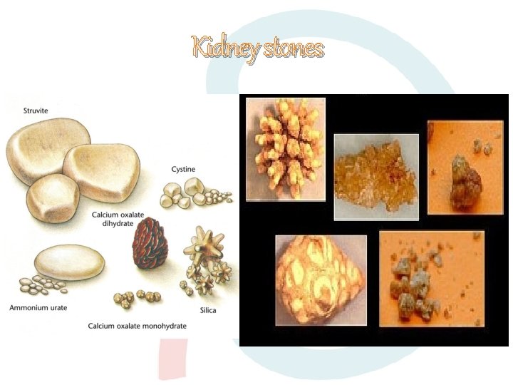 Kidney stones 