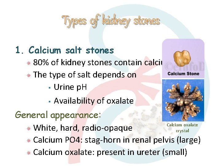 Types of kidney stones 1. Calcium salt stones 80% of kidney stones contain calcium