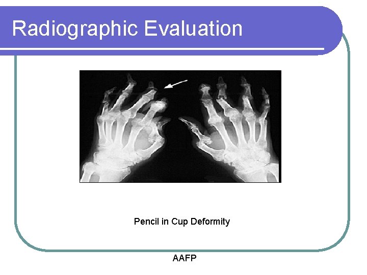 Radiographic Evaluation Pencil in Cup Deformity AAFP 