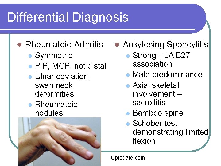 Differential Diagnosis l Rheumatoid Arthritis l l Symmetric PIP, MCP, not distal Ulnar deviation,