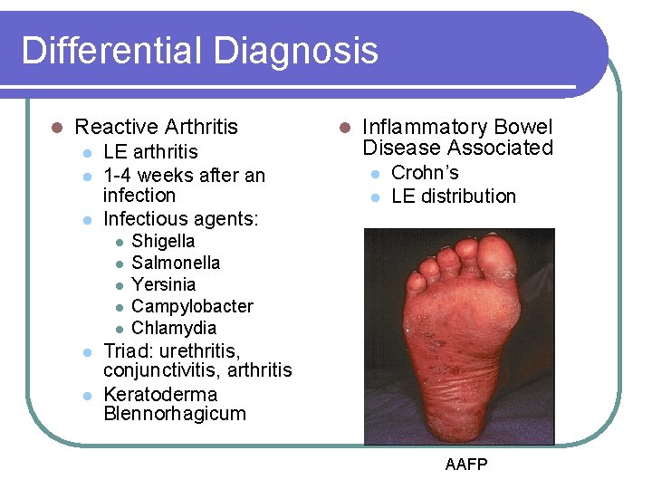 Differential Diagnosis l Reactive Arthritis l l l LE arthritis 1 -4 weeks after