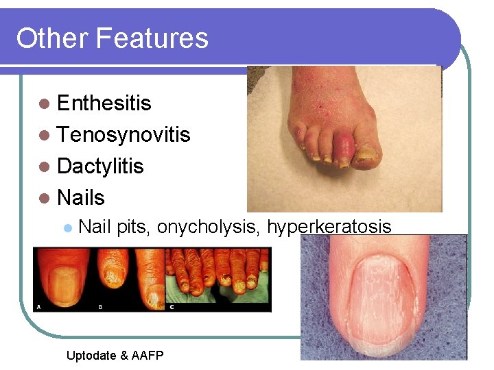 Other Features l Enthesitis l Tenosynovitis l Dactylitis l Nail pits, onycholysis, hyperkeratosis Uptodate