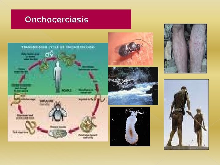 Onchocerciasis 