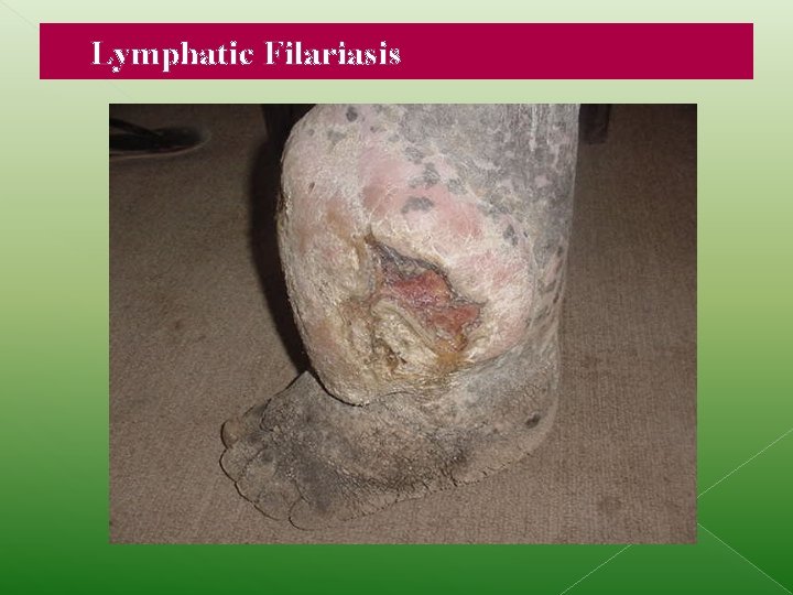 Lymphatic Filariasis 