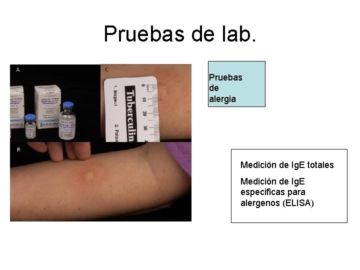 Pruebas de lab. Pruebas de alergia Medición de Ig. E totales Medición de Ig.