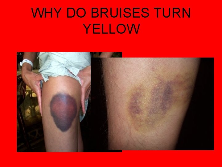 WHY DO BRUISES TURN YELLOW 