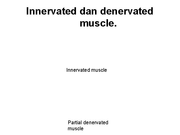 Innervated dan denervated muscle. Innervated muscle Partial denervated muscle 
