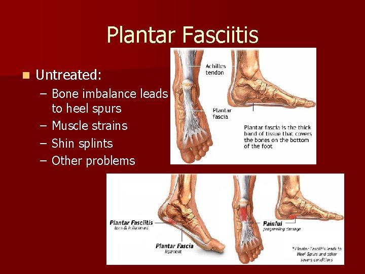 Plantar Fasciitis n Untreated: – Bone imbalance leads to heel spurs – Muscle strains