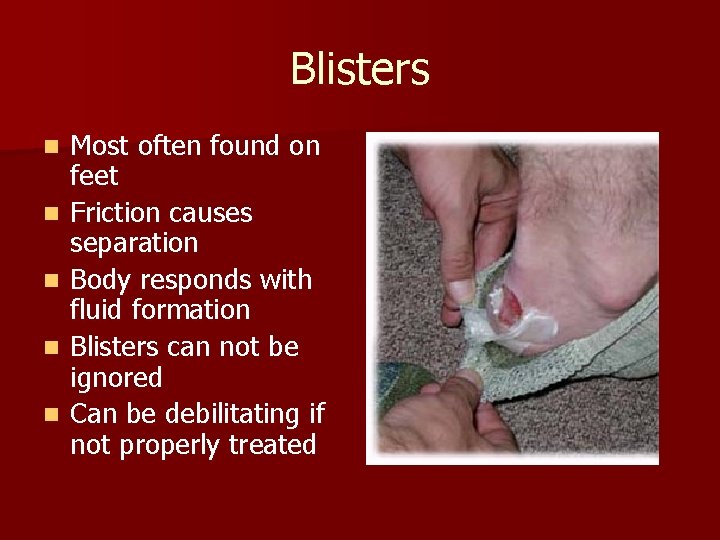 Blisters n n n Most often found on feet Friction causes separation Body responds