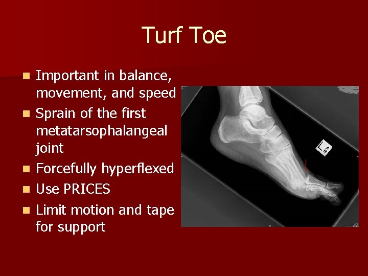 Turf Toe n n n Important in balance, movement, and speed Sprain of the