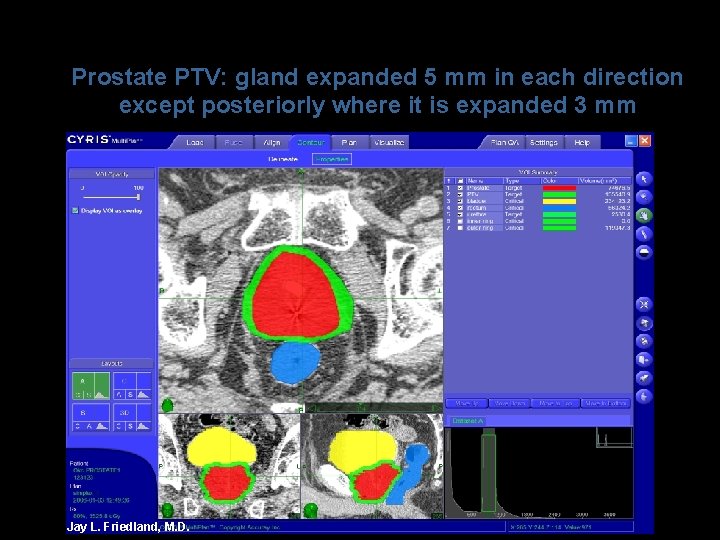 Prostate PTV: gland expanded 5 mm in each direction except posteriorly where it is