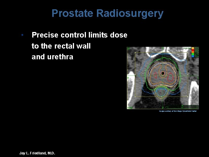 Prostate Radiosurgery • Precise control limits dose to the rectal wall and urethra Image