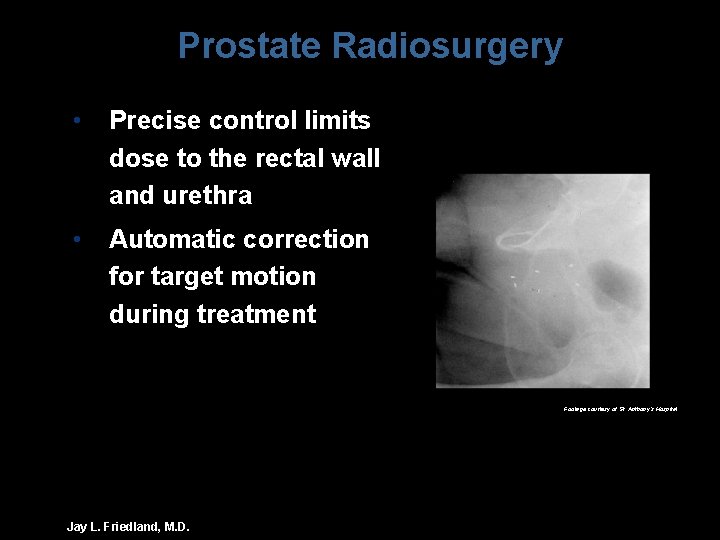 Prostate Radiosurgery • Precise control limits dose to the rectal wall and urethra •