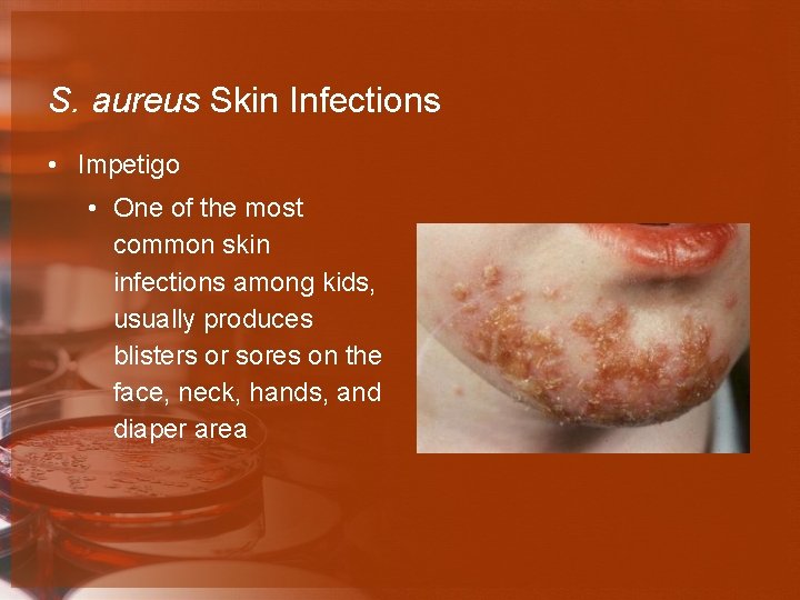 S. aureus Skin Infections • Impetigo • One of the most common skin infections